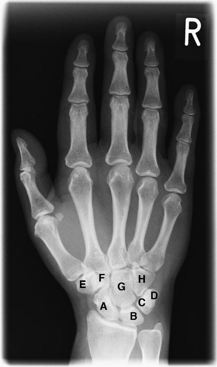 Illustrative hand X-ray, not a Leeds AI output